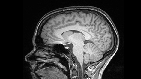 MRI Result